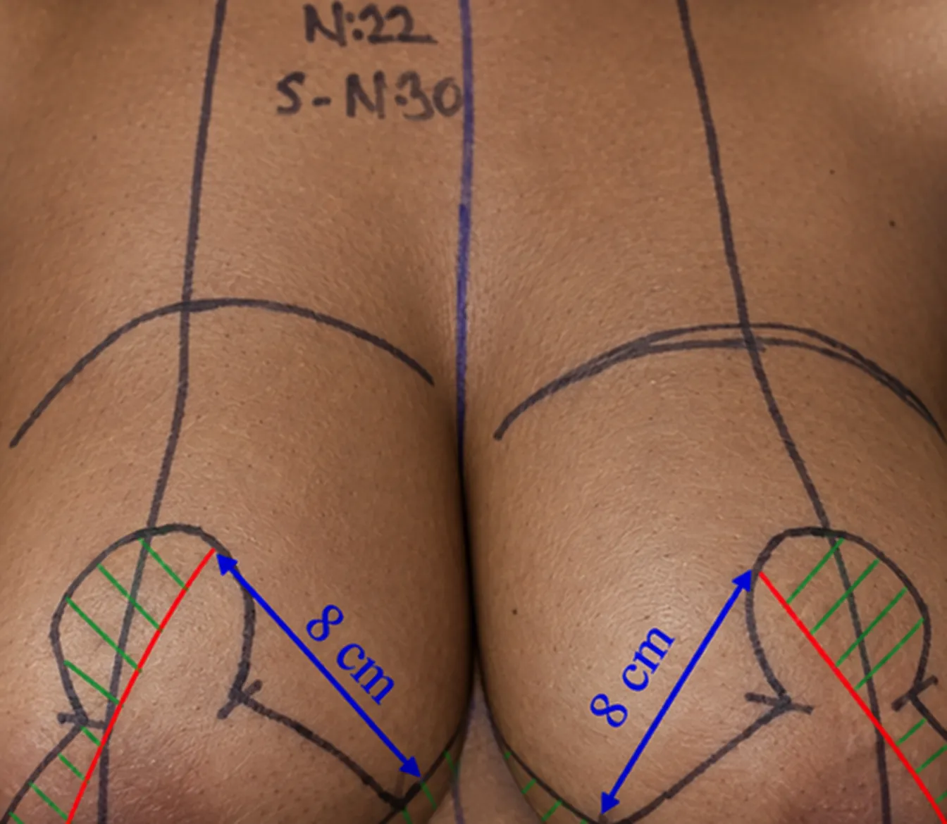 Wise-pattern breast markings with 8 cm pedicle width annotated on skin